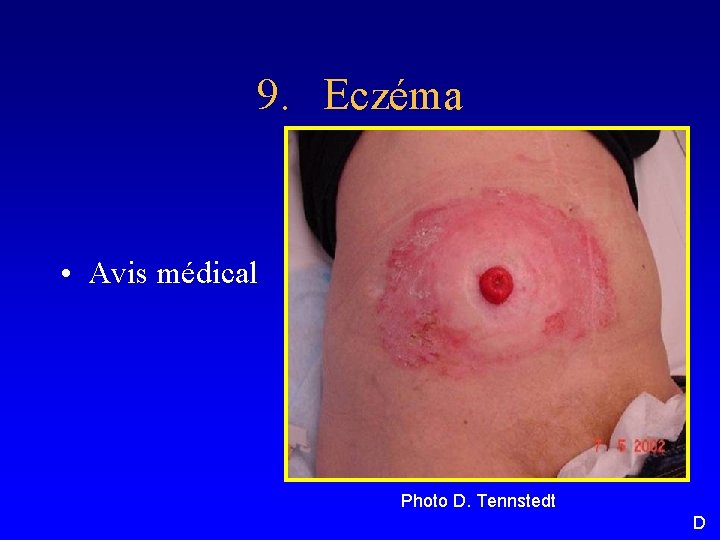 9. Eczéma • Avis médical Photo D. Tennstedt D 