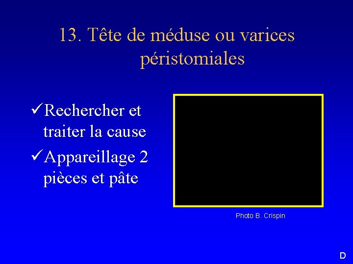 13. Tête de méduse ou varices péristomiales üRecher et traiter la cause üAppareillage 2