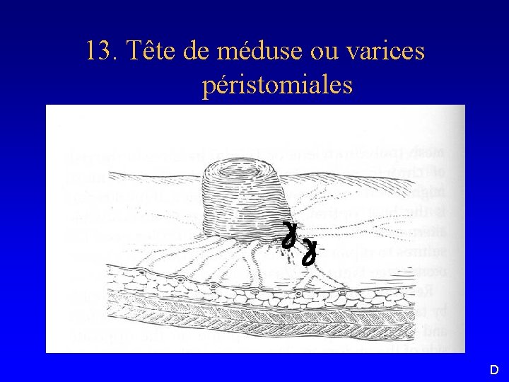 13. Tête de méduse ou varices péristomiales D 