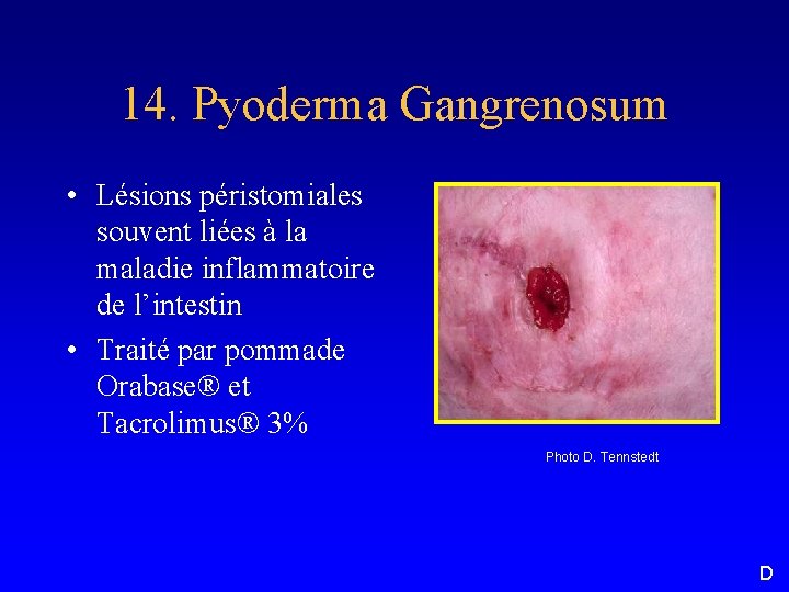 14. Pyoderma Gangrenosum • Lésions péristomiales souvent liées à la maladie inflammatoire de l’intestin