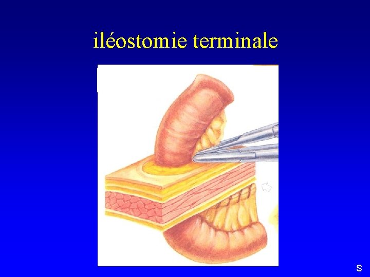 iléostomie terminale S 