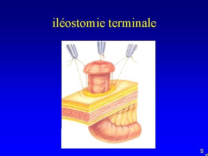 iléostomie terminale S 