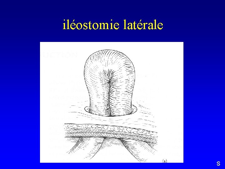iléostomie latérale S 