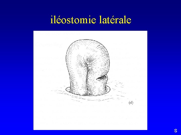 iléostomie latérale S 