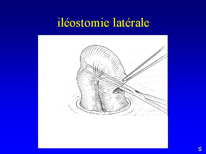 iléostomie latérale S 