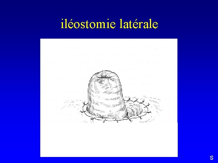 iléostomie latérale S 