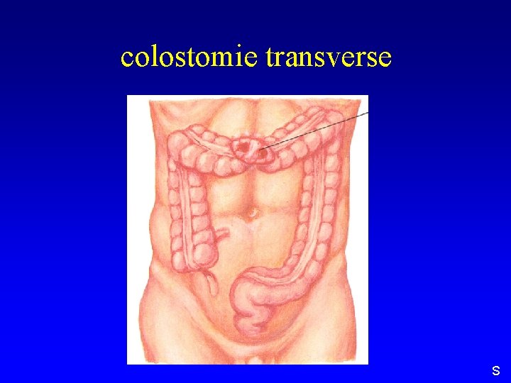 colostomie transverse S 