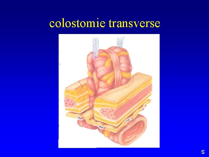 colostomie transverse S 