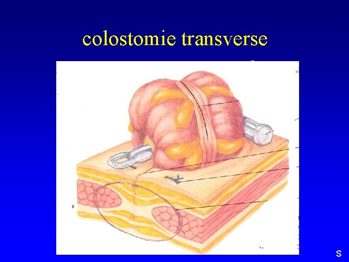 colostomie transverse S 