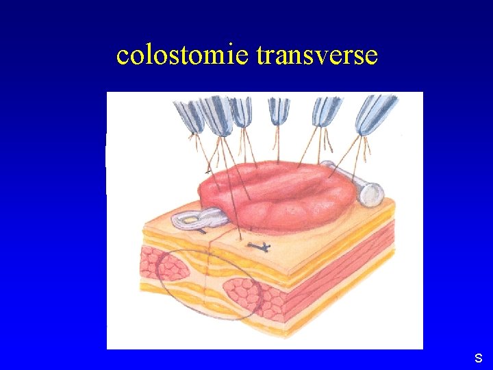 colostomie transverse S 