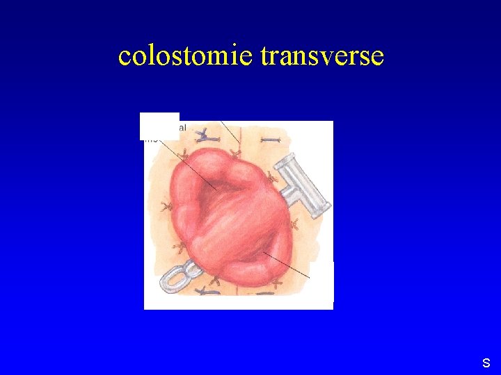 colostomie transverse S 