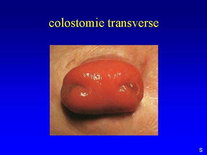 colostomie transverse S 
