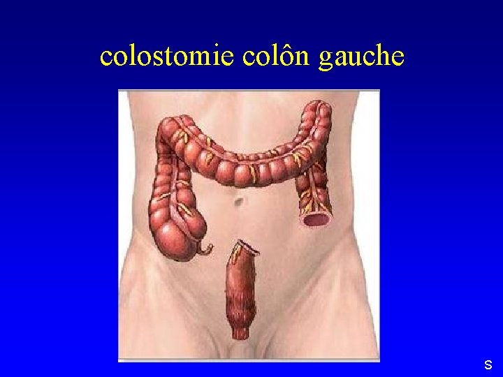 colostomie colôn gauche S 
