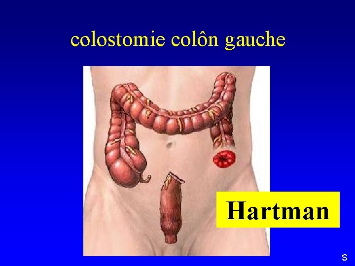 colostomie colôn gauche Hartman S 