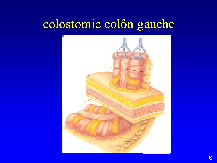 colostomie colôn gauche S 