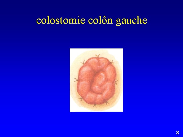 colostomie colôn gauche S 