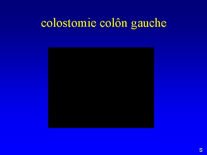 colostomie colôn gauche S 