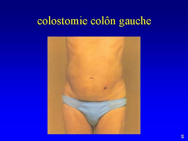 colostomie colôn gauche S 