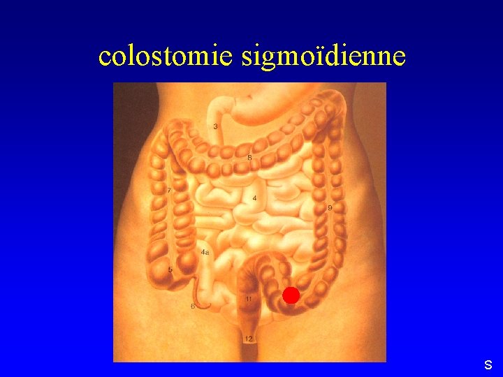 colostomie sigmoïdienne S 