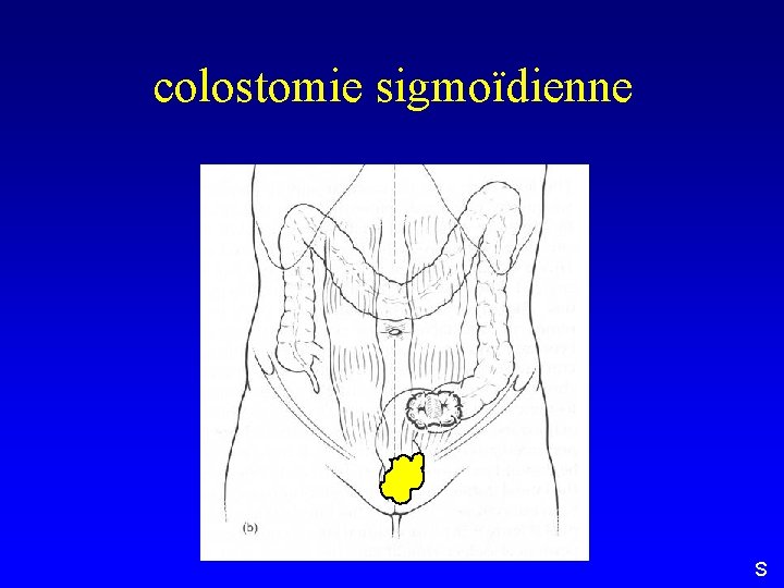 colostomie sigmoïdienne S 