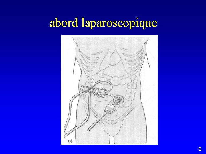 abord laparoscopique S 