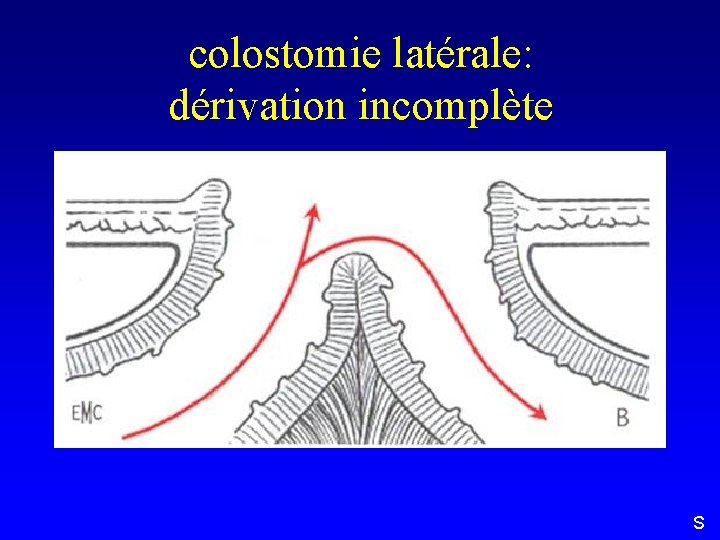 colostomie latérale: dérivation incomplète S 