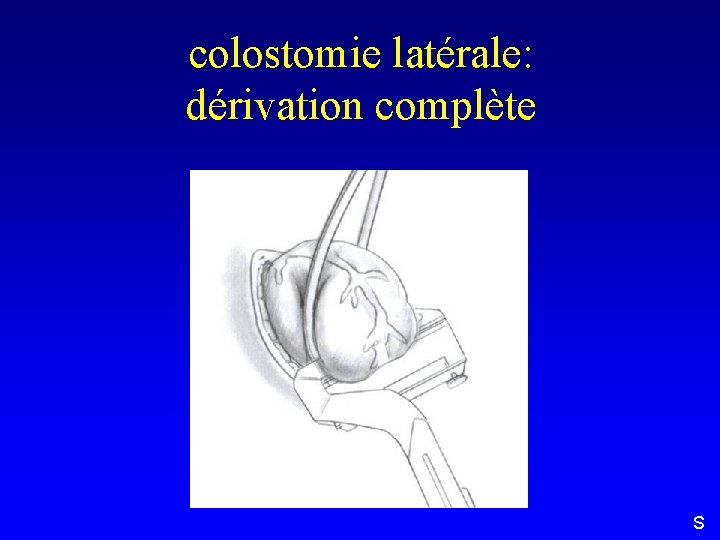 colostomie latérale: dérivation complète S 