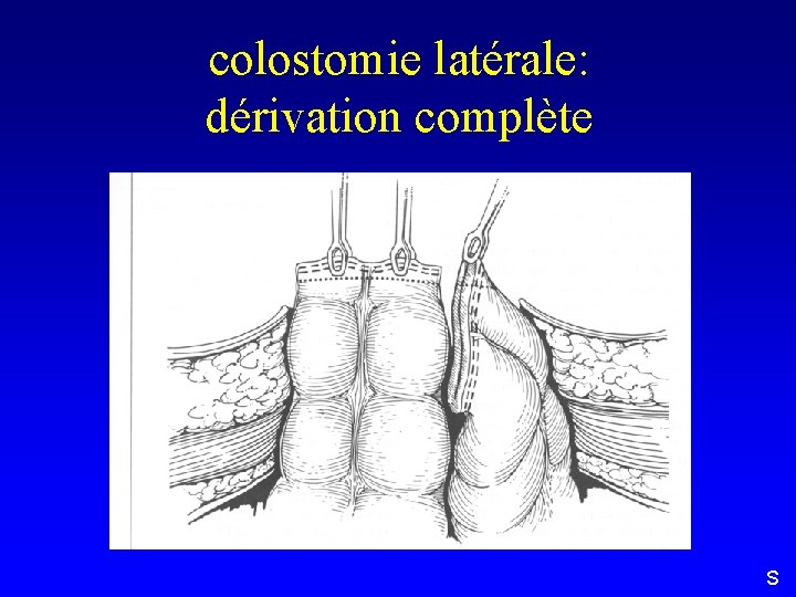 colostomie latérale: dérivation complète S 