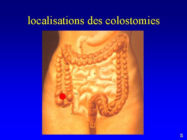 localisations des colostomies S 