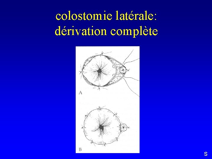 colostomie latérale: dérivation complète S 