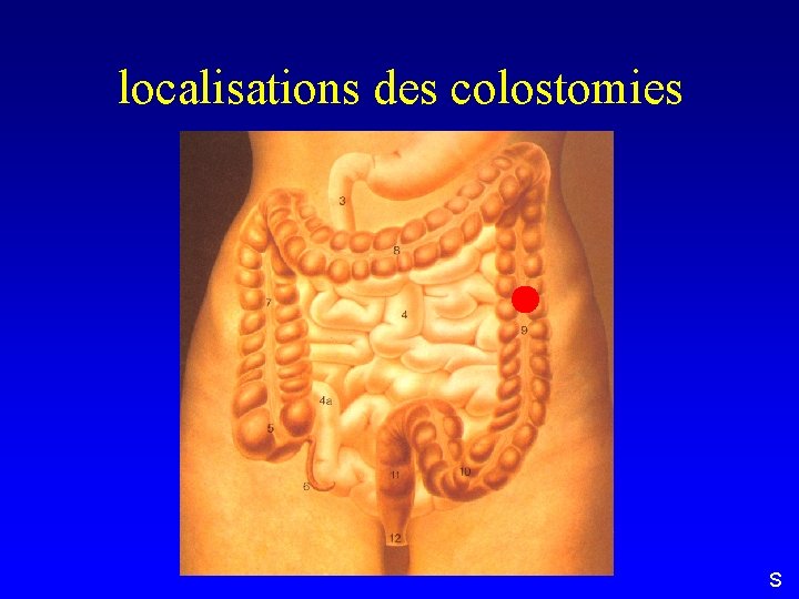 localisations des colostomies S 