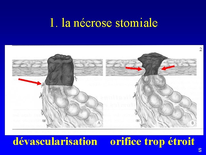 1. la nécrose stomiale dévascularisation orifice trop étroit S 