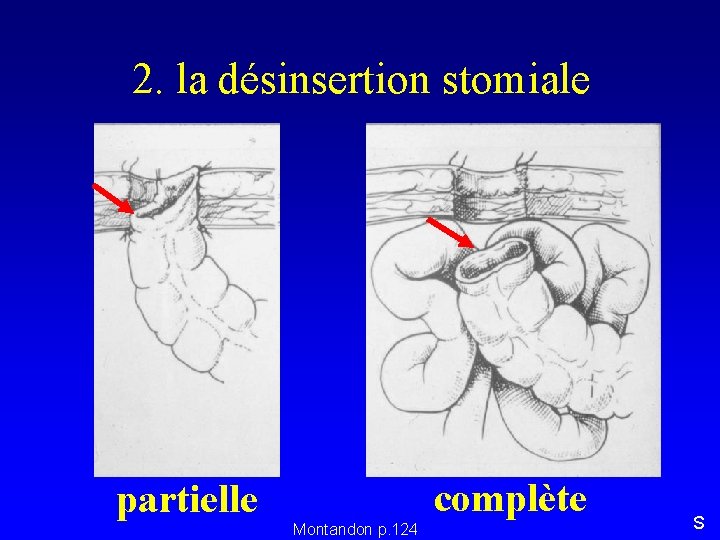 2. la désinsertion stomiale partielle complète Montandon p. 124 S 