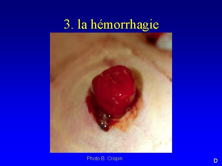 3. la hémorrhagie Photo B. Crispin D 