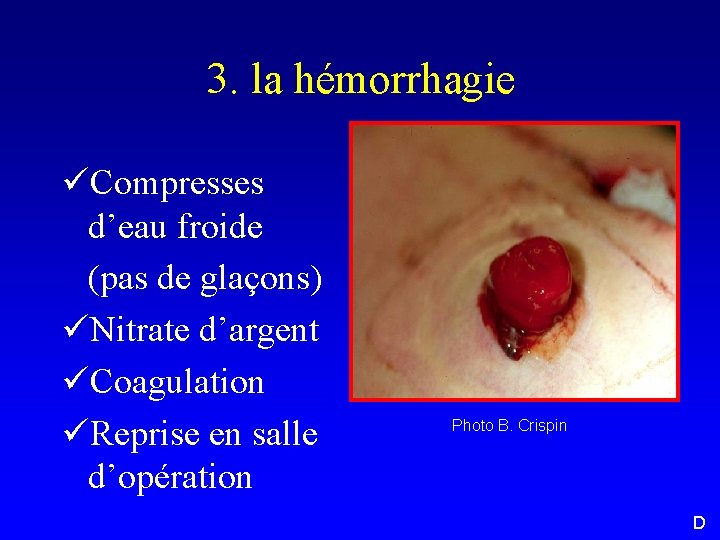 3. la hémorrhagie üCompresses d’eau froide (pas de glaçons) üNitrate d’argent üCoagulation üReprise en