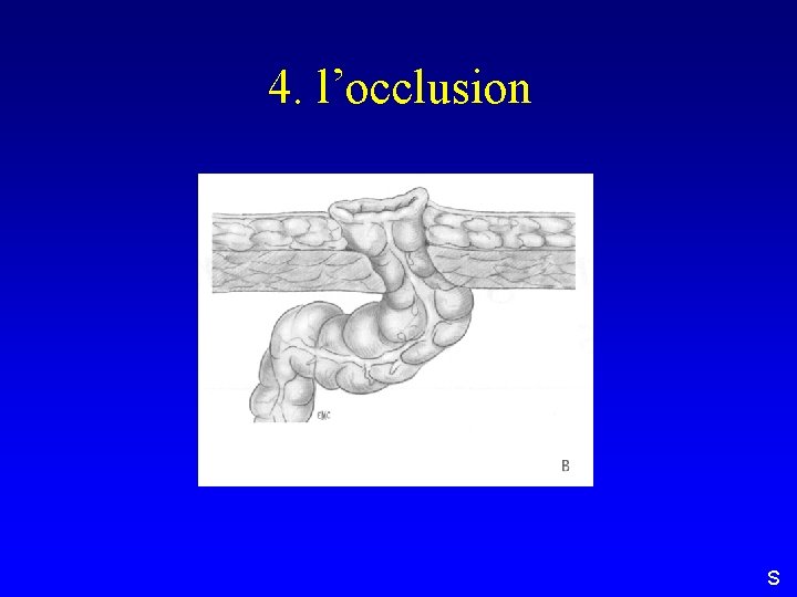 4. l’occlusion S 