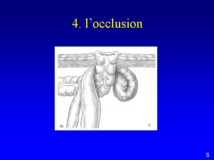 4. l’occlusion S 