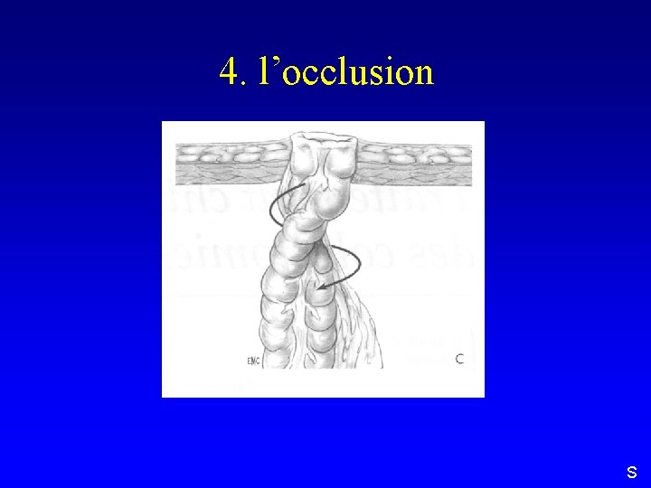 4. l’occlusion S 