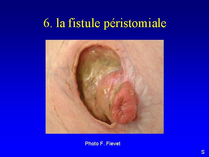 6. la fistule péristomiale Photo F. Fievet S 