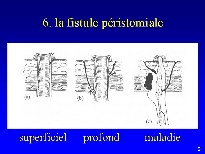 6. la fistule péristomiale superficiel profond maladie S 