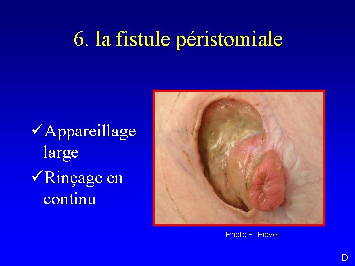 6. la fistule péristomiale üAppareillage large üRinçage en continu Photo F. Fievet D 