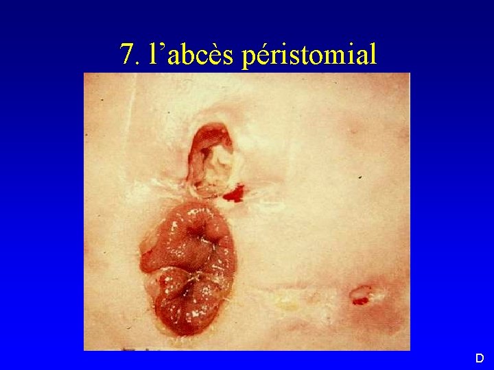 7. l’abcès péristomial D 