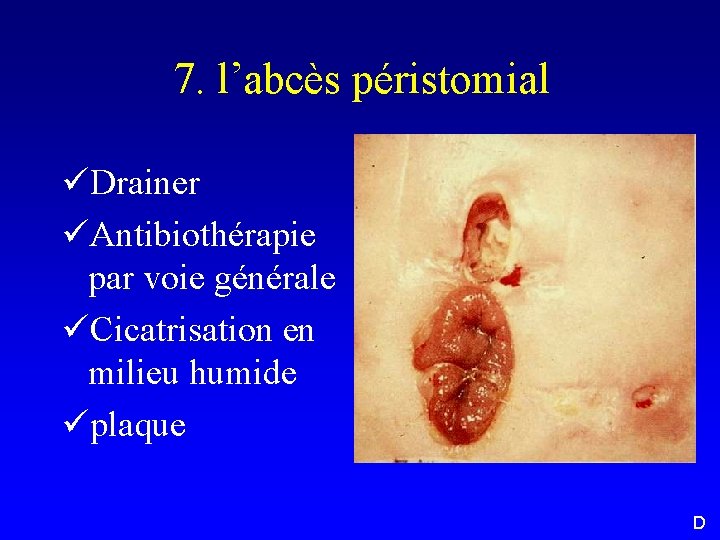 7. l’abcès péristomial üDrainer üAntibiothérapie par voie générale üCicatrisation en milieu humide üplaque D