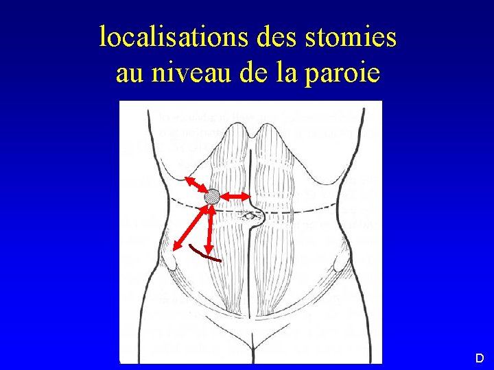 localisations des stomies au niveau de la paroie D 