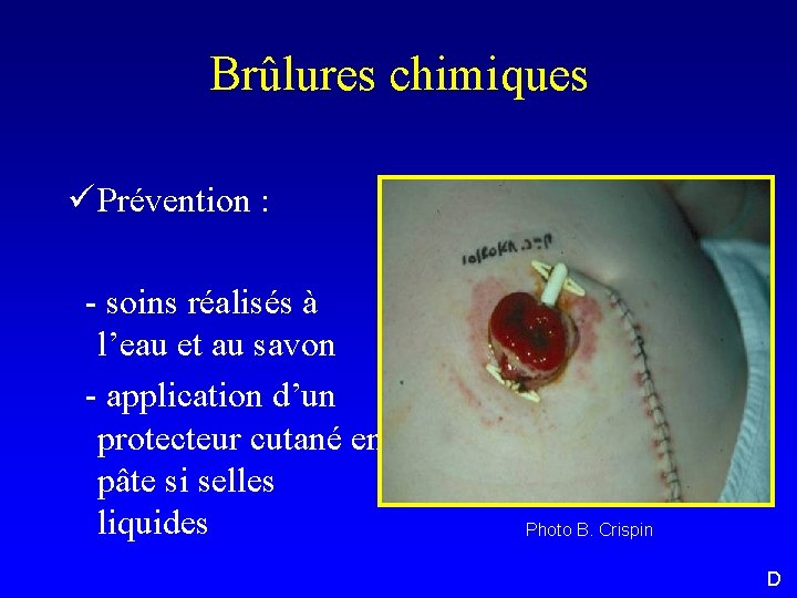 Brûlures chimiques ü Prévention : - soins réalisés à l’eau et au savon -