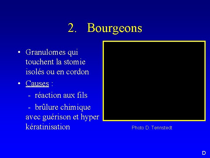 2. Bourgeons • Granulomes qui touchent la stomie isolés ou en cordon • Causes