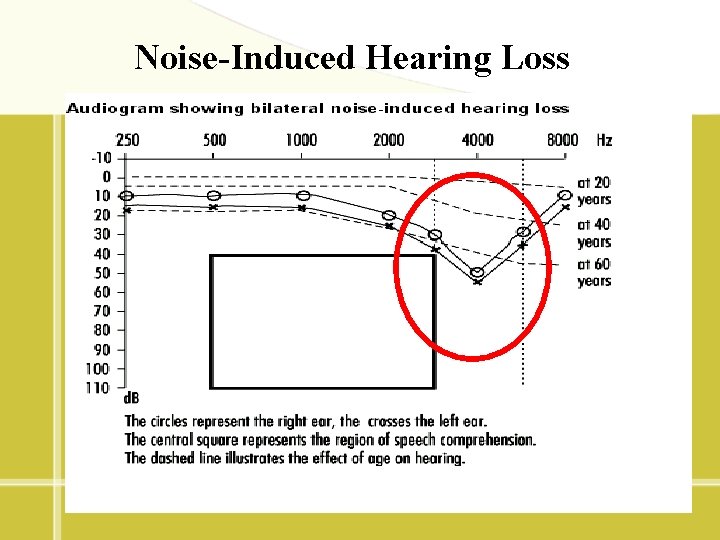 Noise-Induced Hearing Loss 