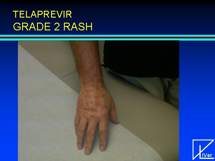 TELAPREVIR GRADE 2 RASH IVer 