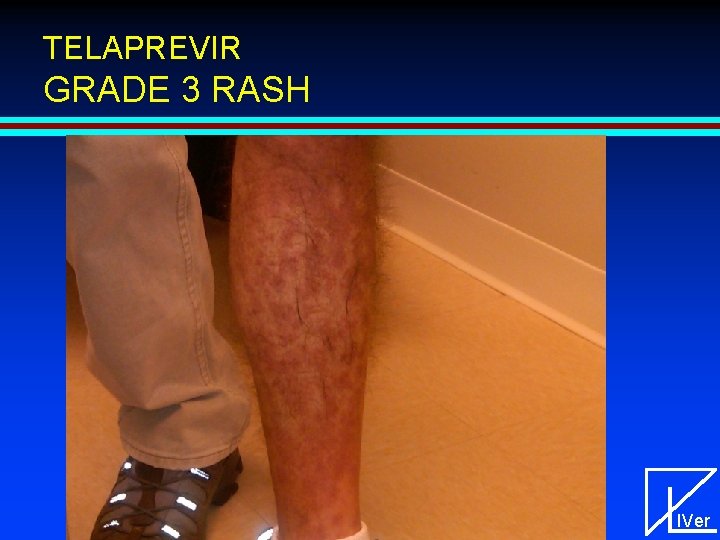 TELAPREVIR GRADE 3 RASH IVer 