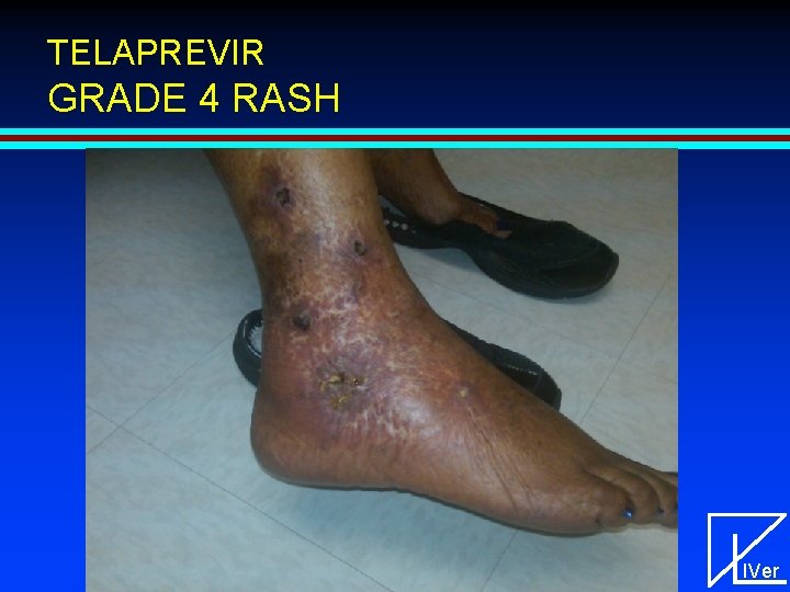 TELAPREVIR GRADE 4 RASH IVer 